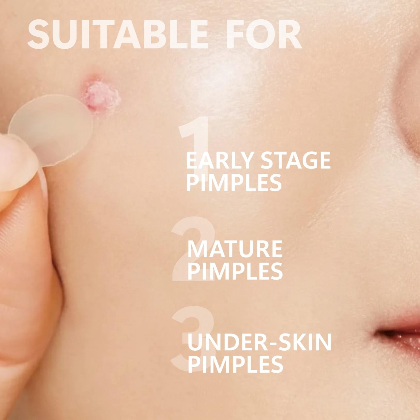 12/24 Pcs Micro Needle Acne Patch, Contains Salicylic Acid Hyaluronic Acid Tea Tree Oil, Single Pack Acne Care, Anti-Acne Treatment