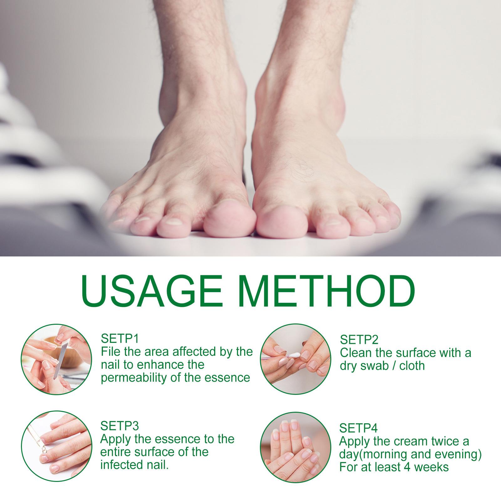 JAYSUING Ginger Nail Treatment | Vitamin E & Plant Essential Oils for Nail Care | Supports Recovery from Onychomycosis, Paronychia, & Nail Deformation | Nail Nutrient Strengthener Oil - Ginger Cuticle Care Oil for Nails