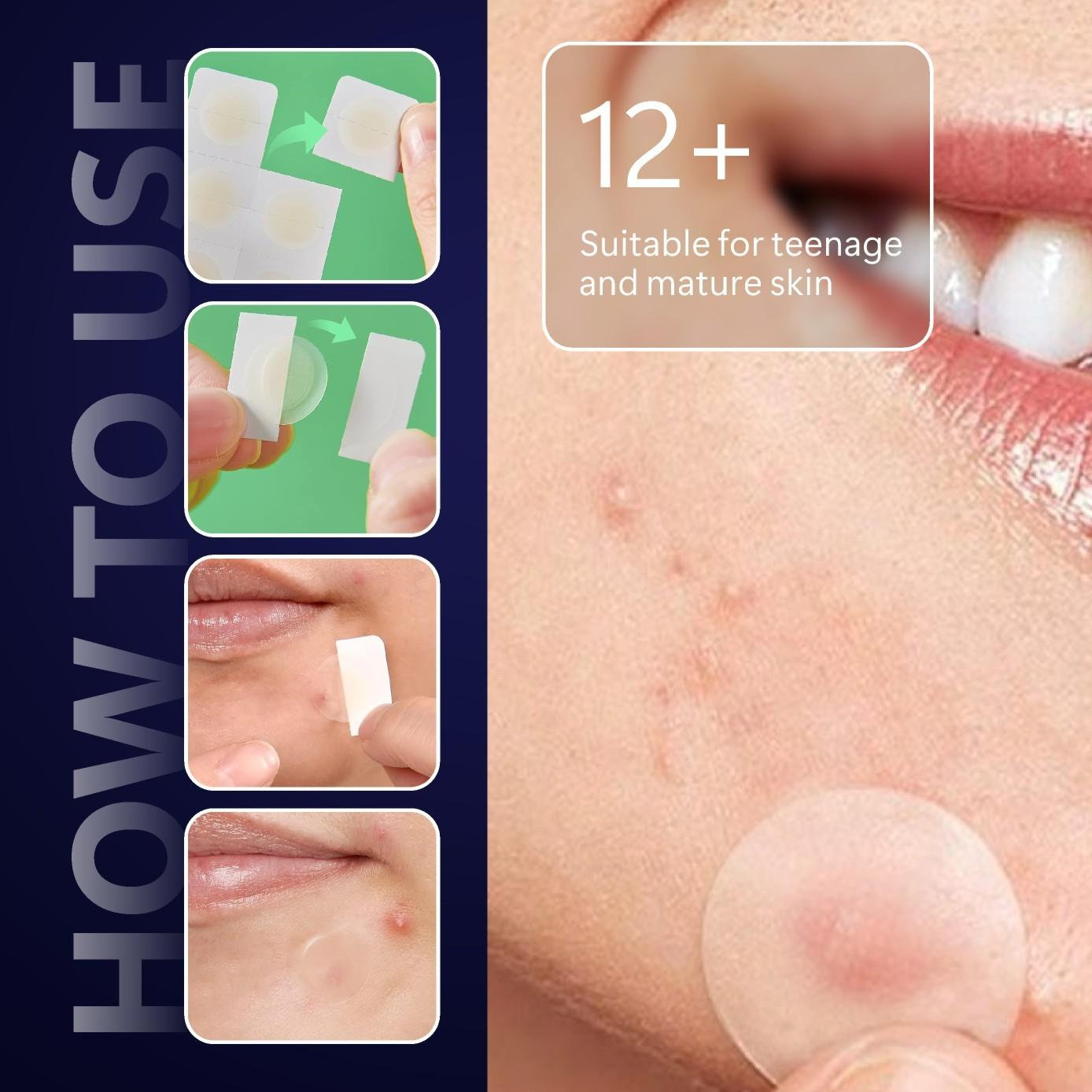 KHAZX 12/24pcs Microneedle Gentle Care Patches, Acne Treatment Patches, Single Item, Non-Flammable, Made in China