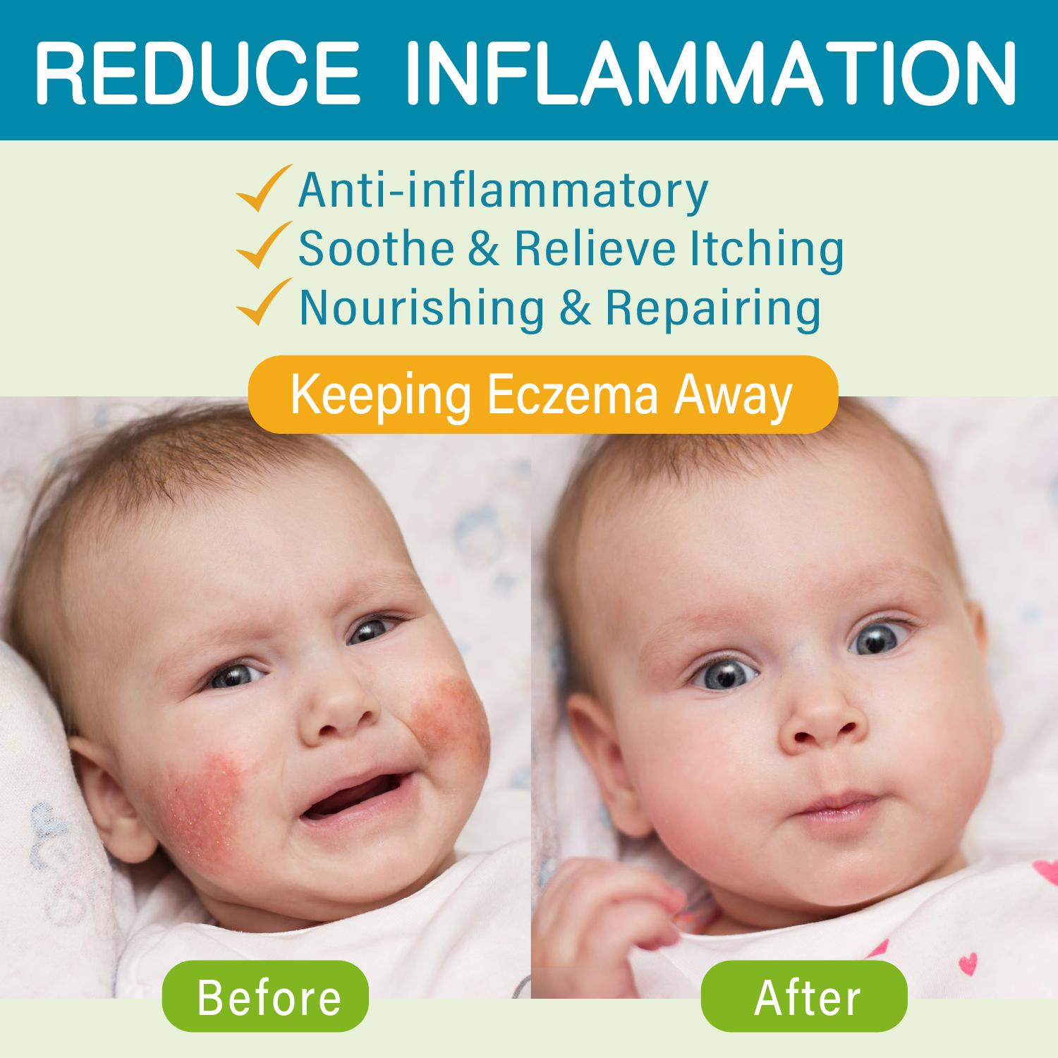 Baby Eczema Cream - Kids Eczema Therapy & Relief Body Cream, Nourishing Skin Protectant for Dry, Itchy Skin, Hypoallergenic,baby rash cream face,3.38oz/100ml