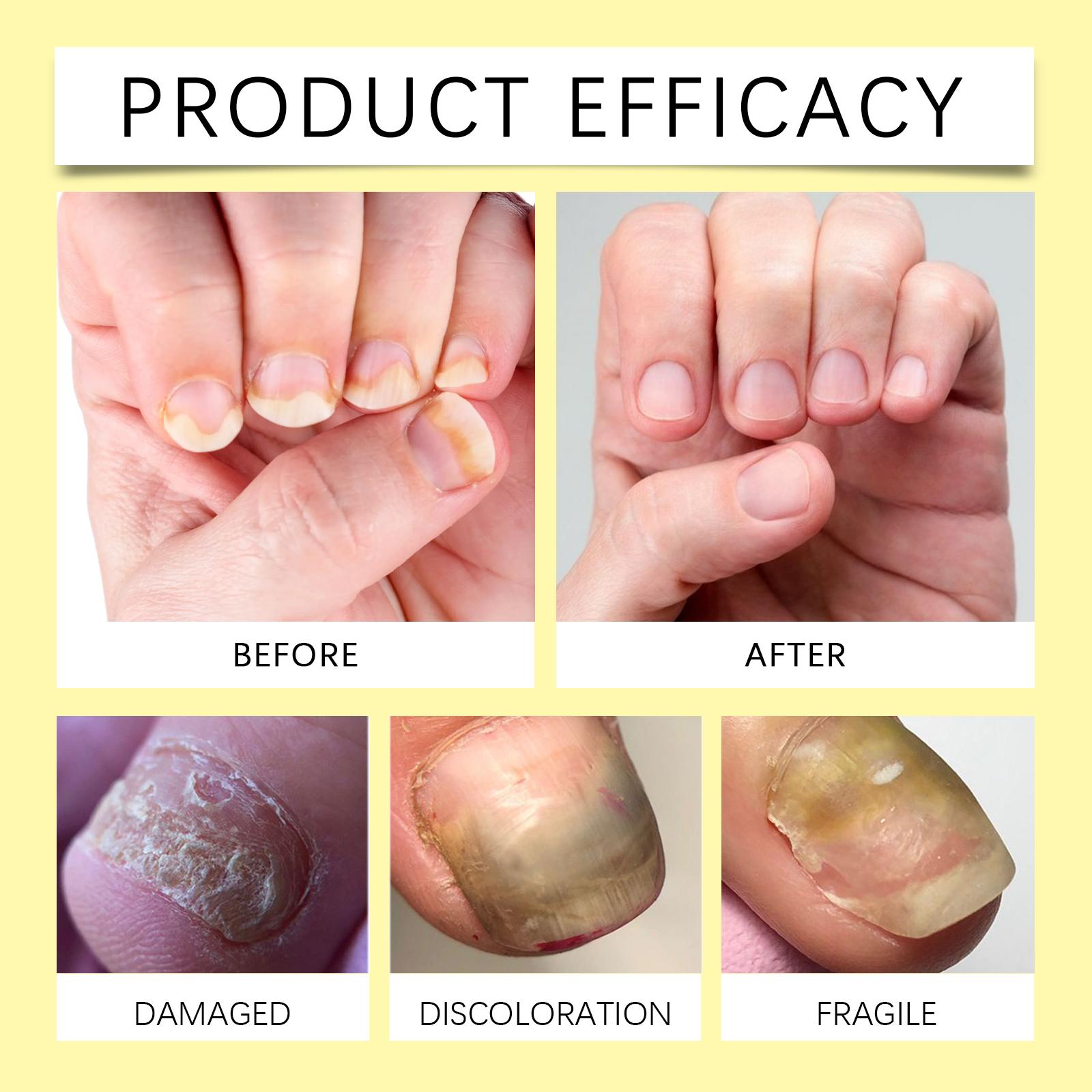 Ximonth Herbal Nail Care Solution Hand, Foot And Nail Cleansing And Repair Bright Nail Thick Toe Care Solution