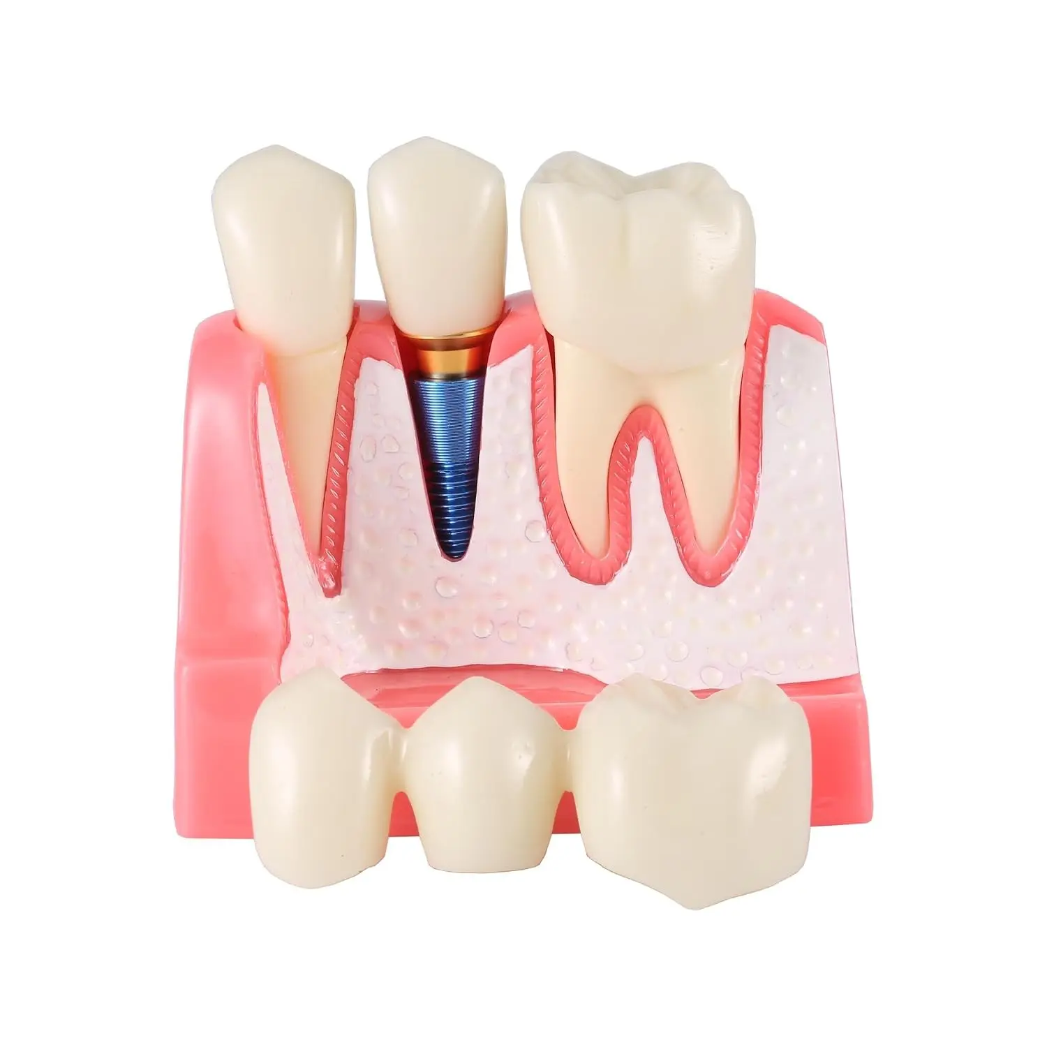 Dental Implant Teeth Demo Model, 4x Size with Removable Crown & Bridge, Teaching Tool & Study Aid