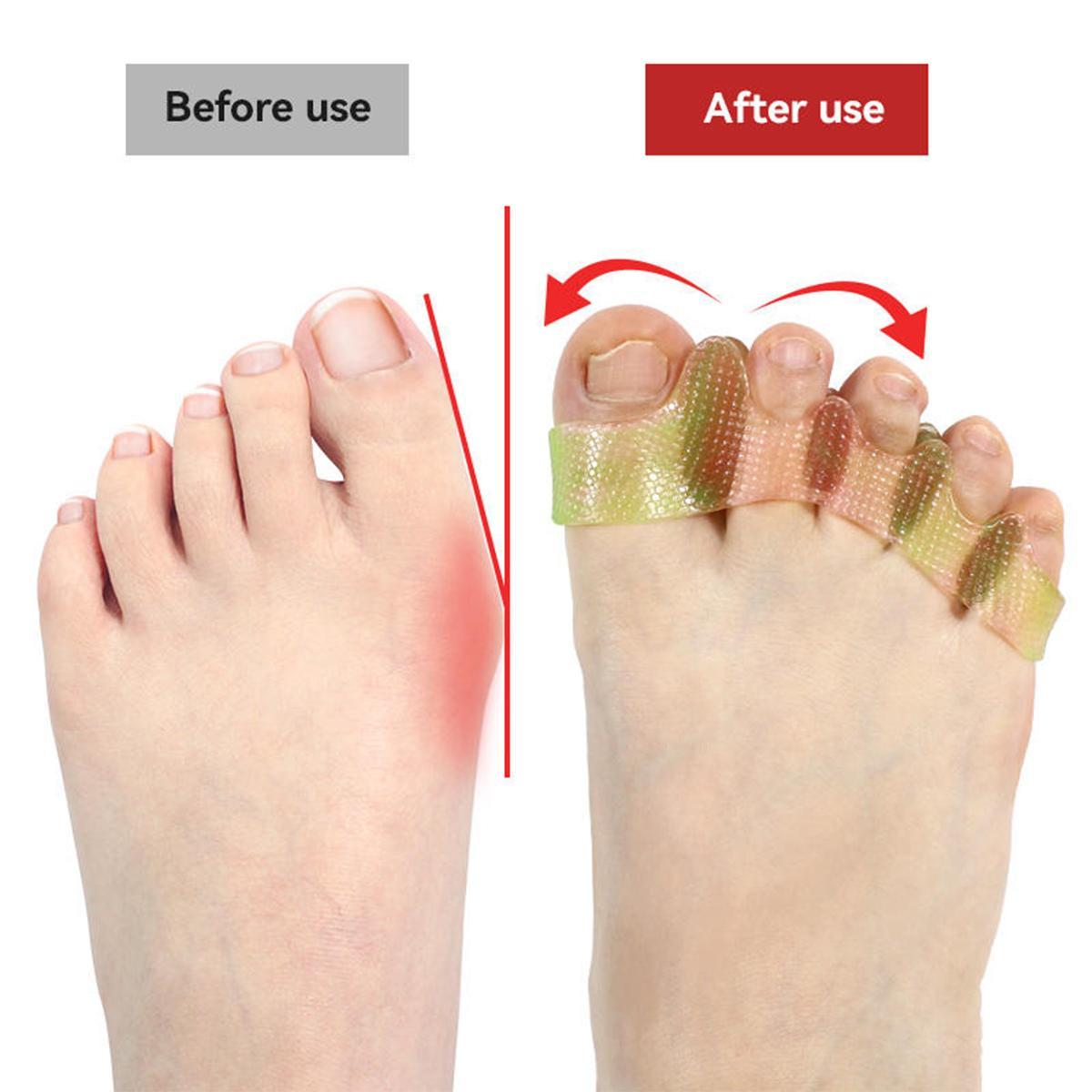 Toe Separators/Toe Spacers - For Men and Women - Correcting Bunions and Restoring Toes to Their Original Shape Suitable for Barefoot and Minimalists SpringStatements