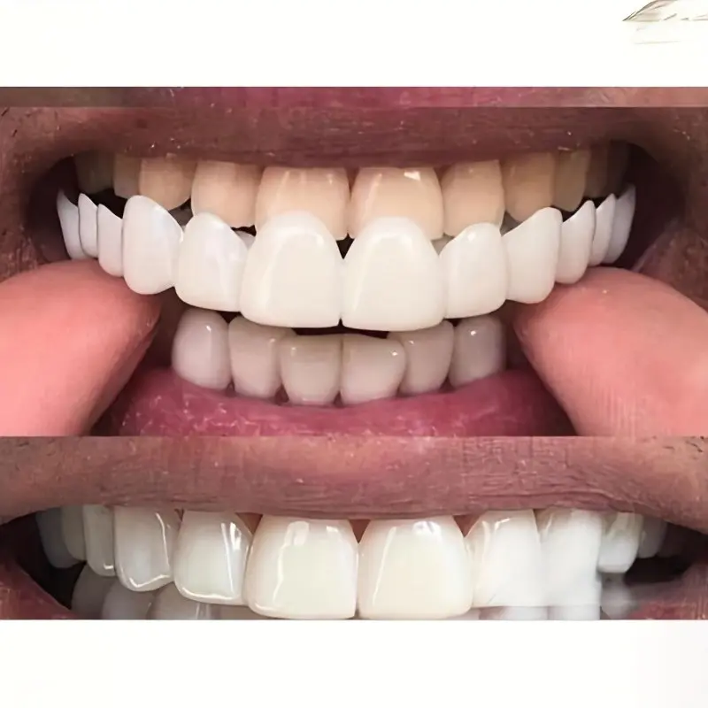 A Set of 4 Dentures, Including White Upper and Lower Teeth, Plus 2 Height-increasing Teeth, with Soft and Comfortable White Dental Trays to Add Height. The Transparent Design Is Made of Durable EVA Material.